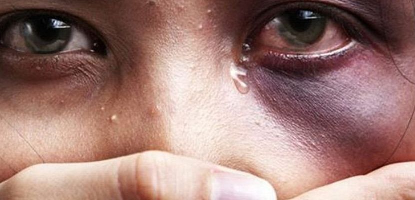 mulher com o olho roxo e com a mão na boa. só aparece a face